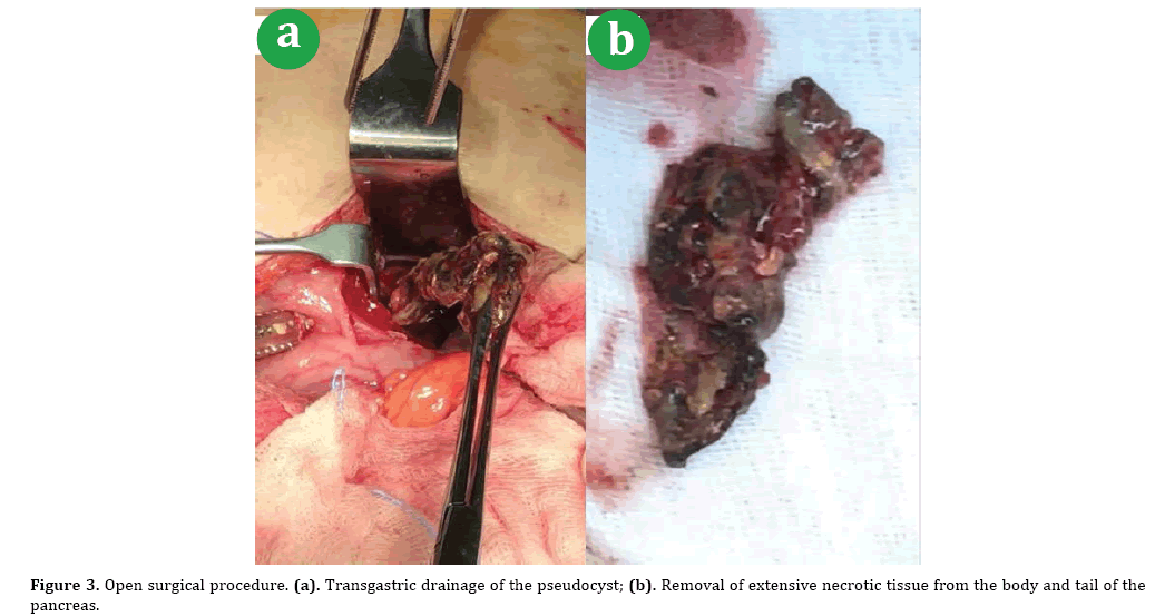 pancreas-pseudocyst