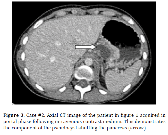 pancreas-pseudocyst-pancreas