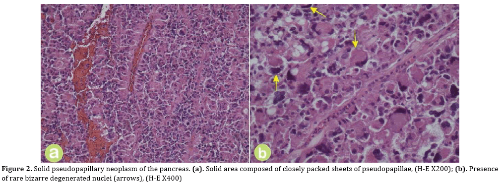 pancreas-pseudopapillary