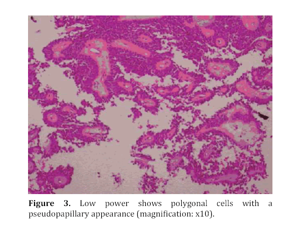 pancreas-pseudopapillary-appearance