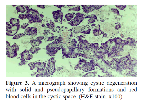 pancreas-pseudopapillary-formations