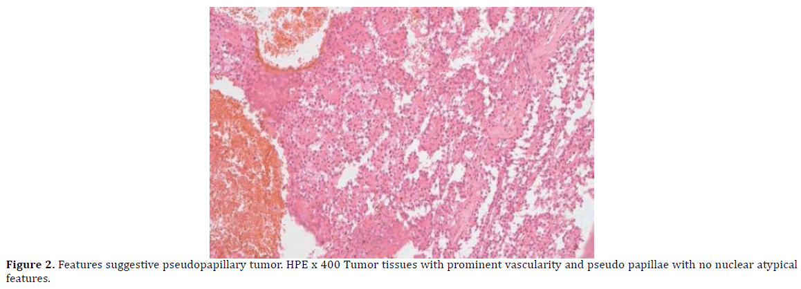 pancreas-pseudopapillary-tumor