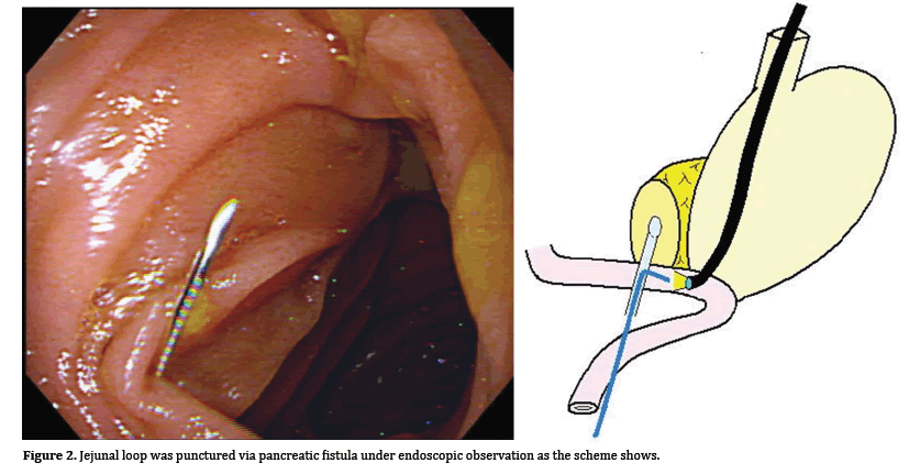 pancreas-punctured