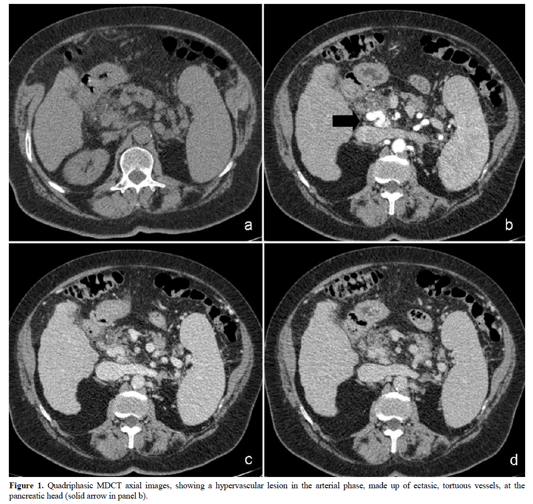 pancreas-quadriphasic-hypervascular-lesion