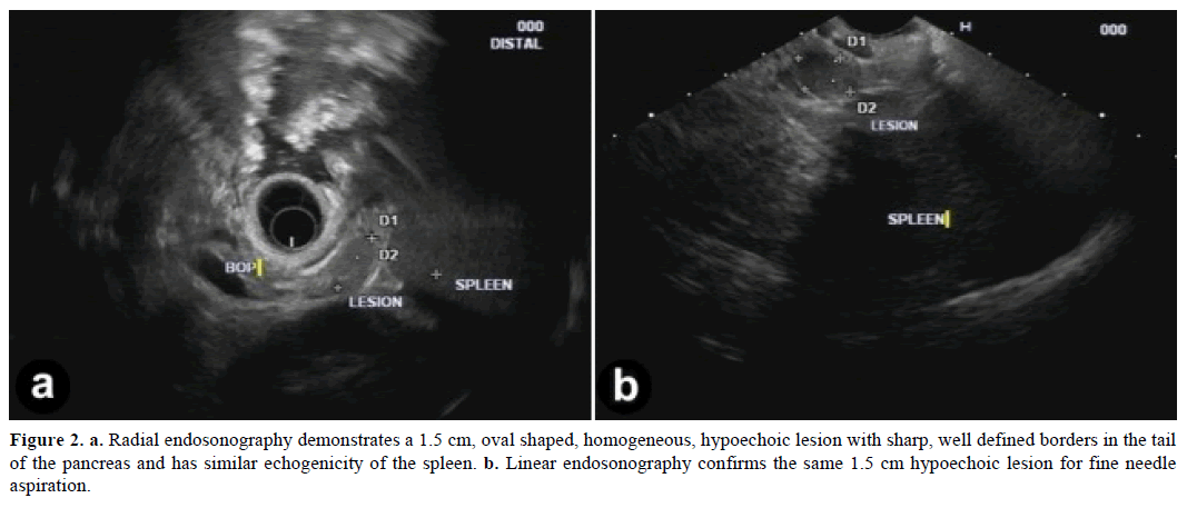 pancreas-radial-endosonography-demonstrates