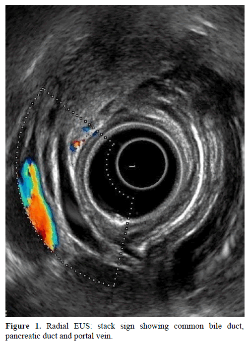 pancreas-radial-eus-stack-sign