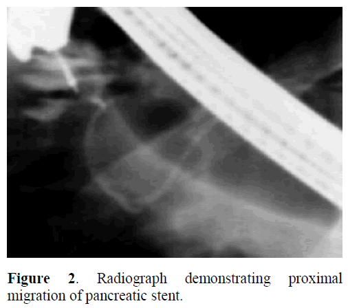 pancreas-radiograph-proximal-migration