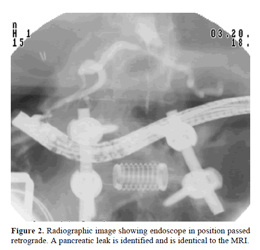 pancreas-radiographic-retrograde