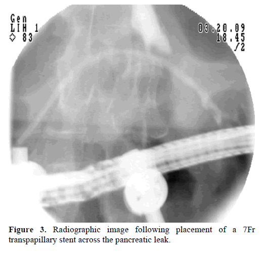 pancreas-radiographic-transpapillary