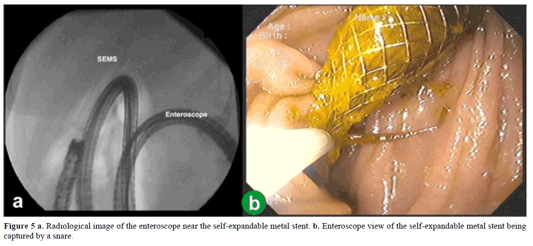 pancreas-radiological-image-enteroscope