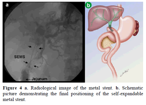 pancreas-radiological-image-metal-stent