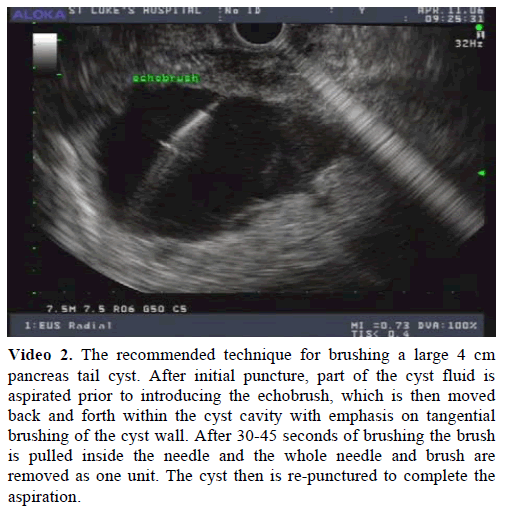 pancreas-recommended-technique-tail-cyst