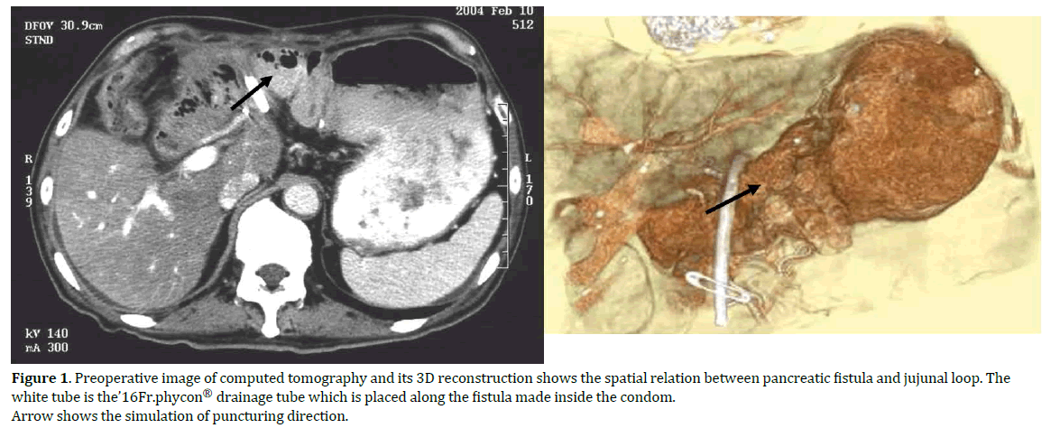 pancreas-reconstruction