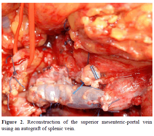pancreas-reconstruction-mesenteric