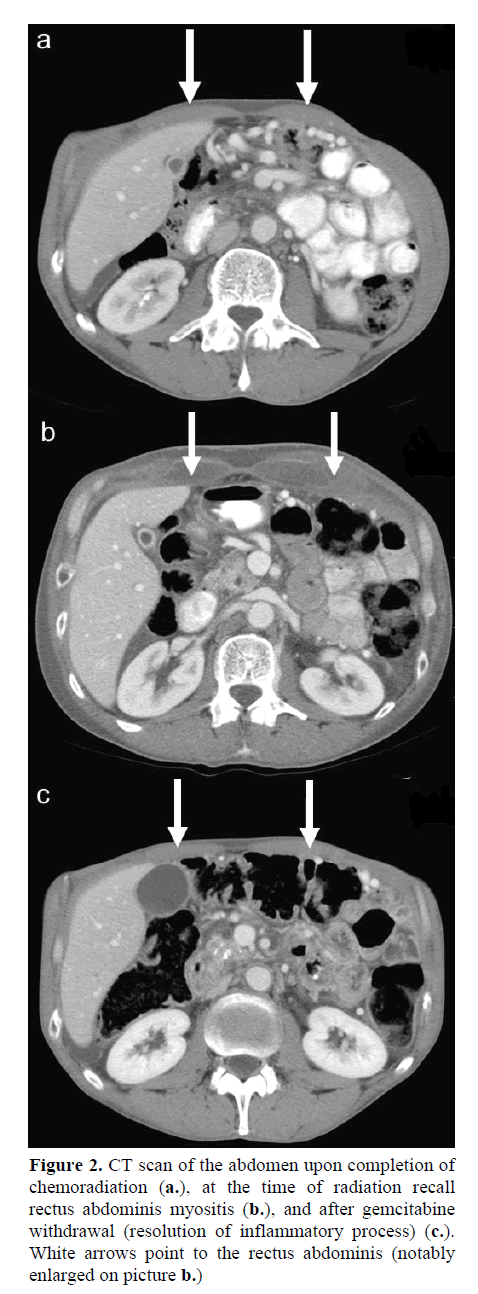 pancreas-rectus-abdominis-myositis