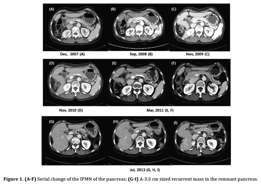 pancreas-recurrent-mass-remnant