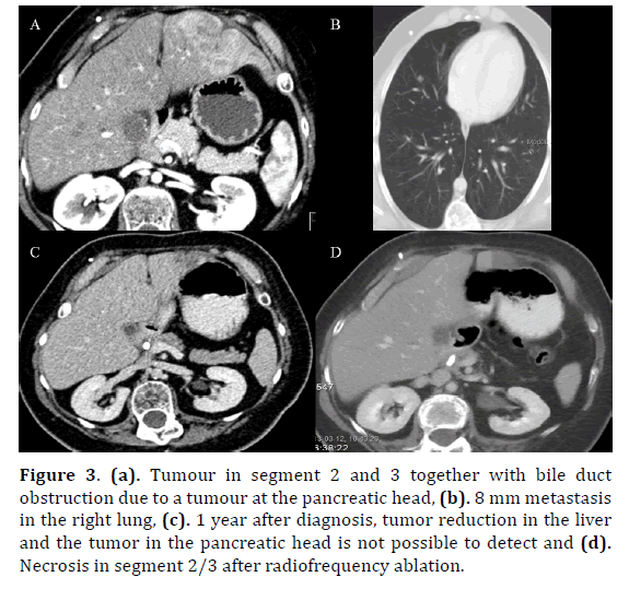 pancreas-reduction