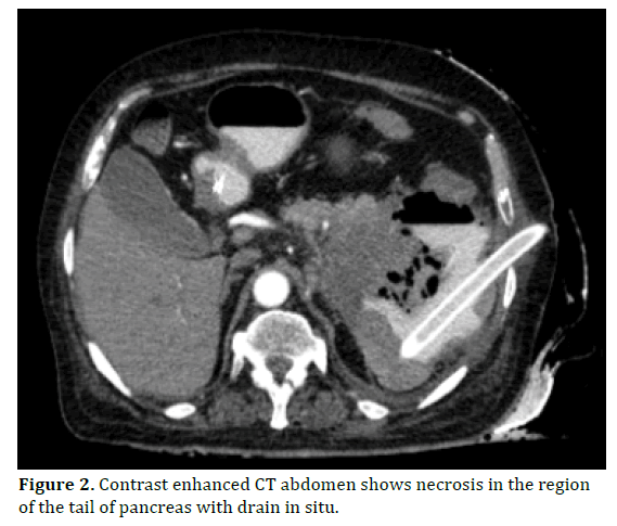 pancreas-region