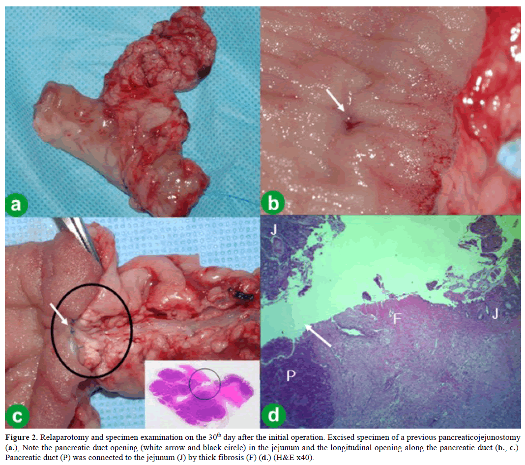 pancreas-relaparotomy-specimen-examination