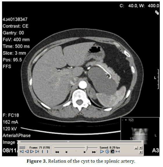 pancreas-relation-cyst-splenic-artery