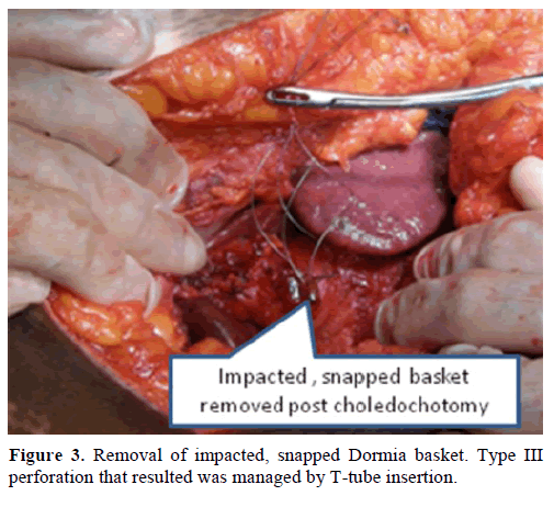 pancreas-removal-impacted-snapped-dormia