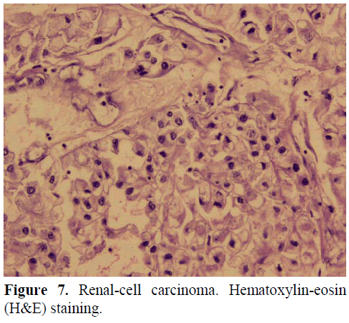 pancreas-renal-cell-carcinoma-hematoxylin