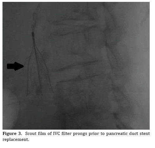 pancreas-replacement