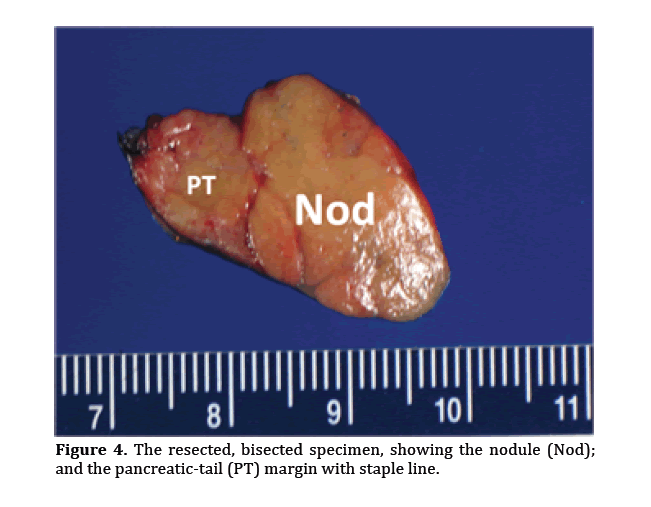 pancreas-resected-bisected-specimen