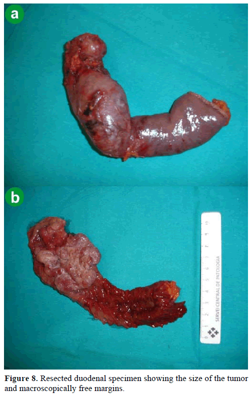 pancreas-resected-duodenal-specimen