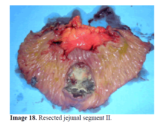 pancreas-resected-jejunal-segment