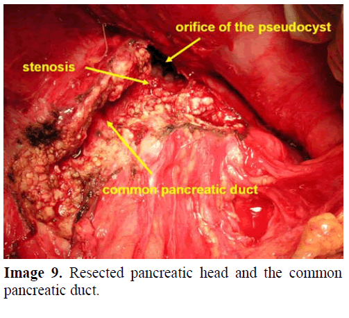 pancreas-resected-pancreatic-head