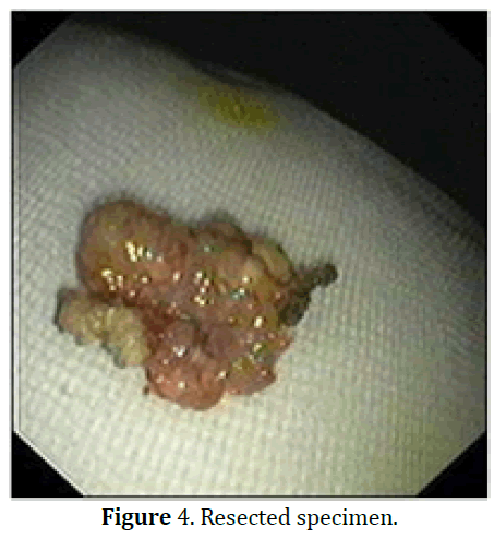 pancreas-resected-specimen