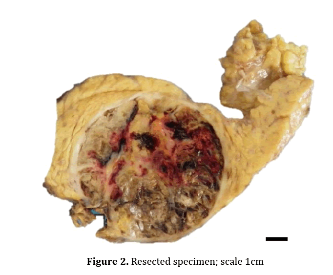 pancreas-resected-specimen