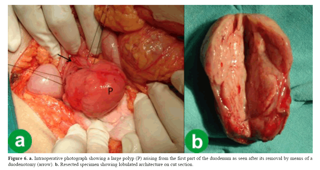 pancreas-resected-specimen-showing