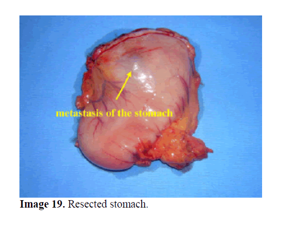 pancreas-resected-stomach