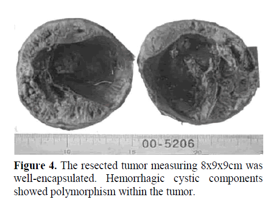 pancreas-resected-tumor-measuring