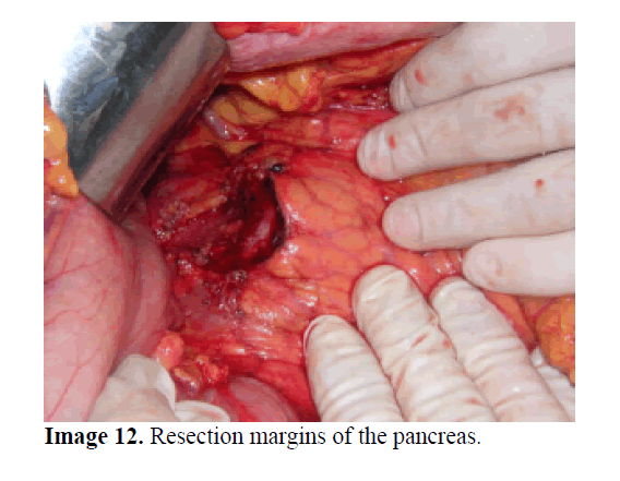 pancreas-resection-margins-pancreas