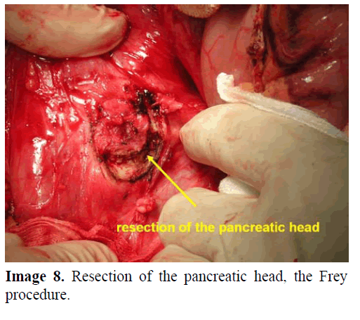 pancreas-resection-pancreatic-head