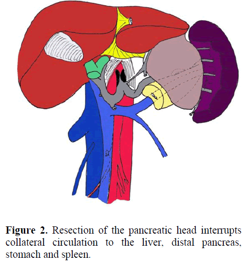 pancreas-resection-pancreatic-interrupts