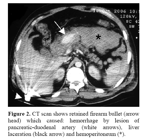 pancreas-retained-firearm-bullety