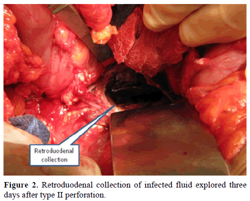 pancreas-retroduodenal-collection-infected