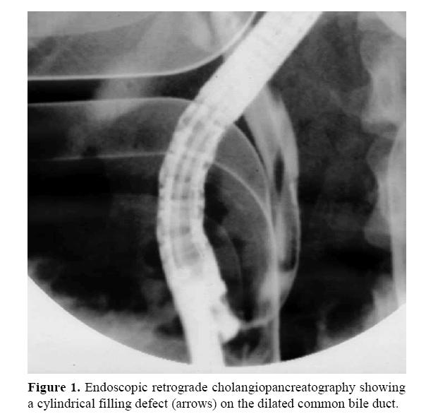 pancreas-retrograde-cholangiopancreatography