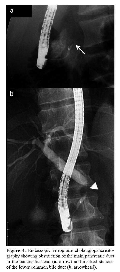 pancreas-retrograde-cholangiopancreatography