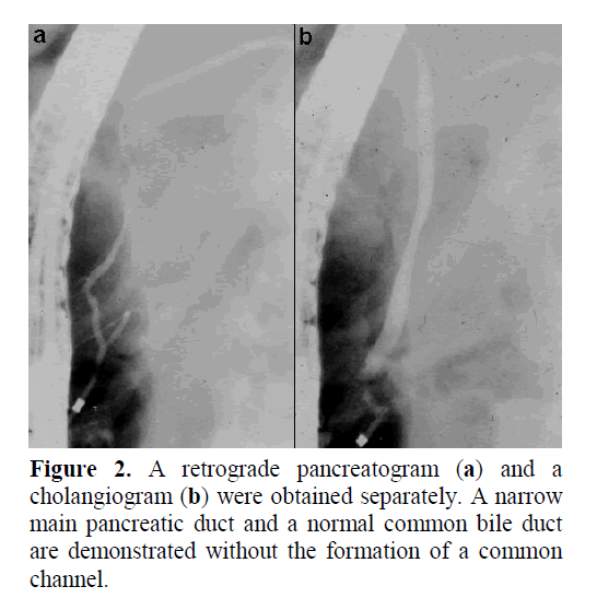 pancreas-retrograde-pancreatogram