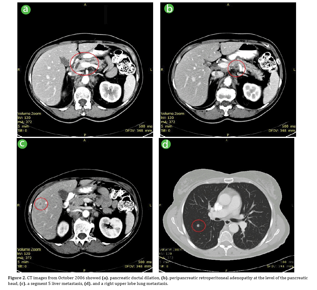 pancreas-retroperitoneal