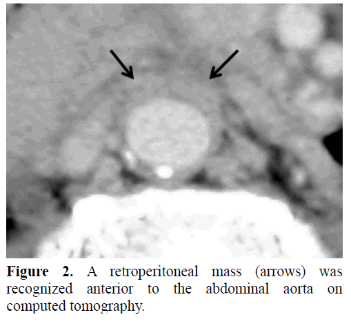 pancreas-retroperitoneal-anterior