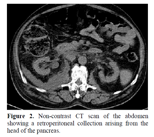 pancreas-retroperitoneal-collection-arising