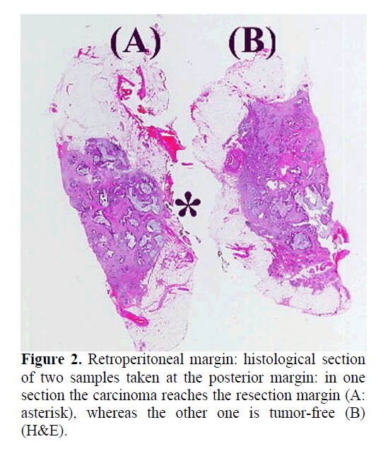 pancreas-retroperitoneal-margin