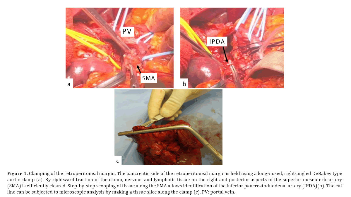 pancreas-retroperitoneal-margin