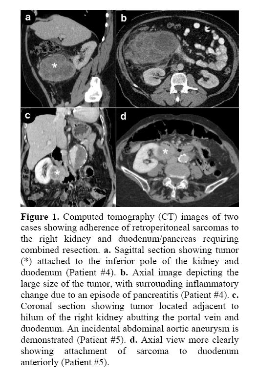 pancreas-retroperitoneal-sarcomas